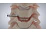 do 3d medical animation cervical disc replacement spine surgery anatomy video